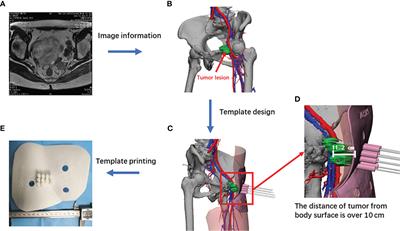 Dosimetric parameters and safety analysis of 3D-printing non-coplanar template-assisted interstitial brachytherapy for non-centrally recurrent cervical cancer